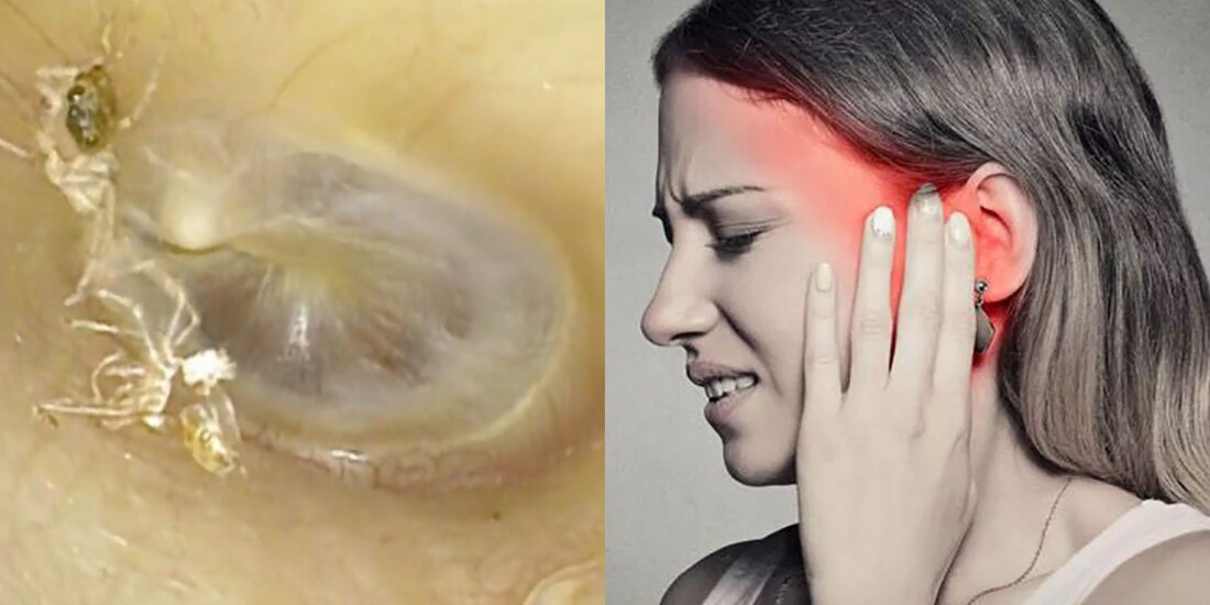 Mujer acude al médico porque 'sentía que algo caminaba' en su oído izquierdo y los doctores encontraron una araña viva dentro de él.