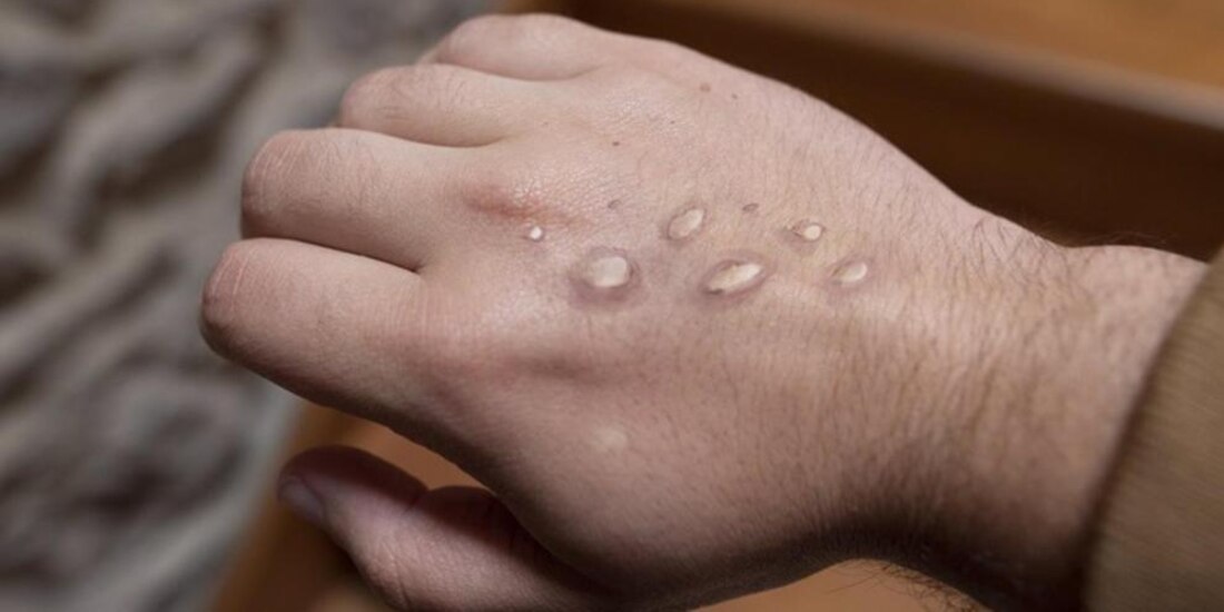 Se registran 128 casos de viruela símica en 2 semanas.