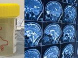 Médicos retiran una lombriz viva del cerebro de una mujer de 64 años; este parasito solo vive en los estómagos de los pitones.