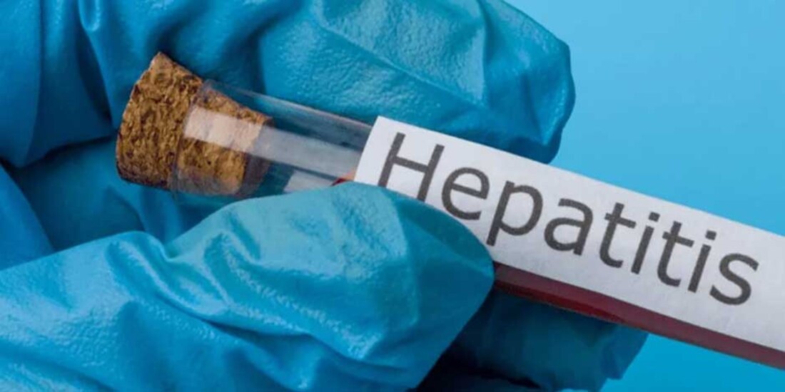 Reportan caso sospechoso de hepatitis aguda infantil en Nayarit