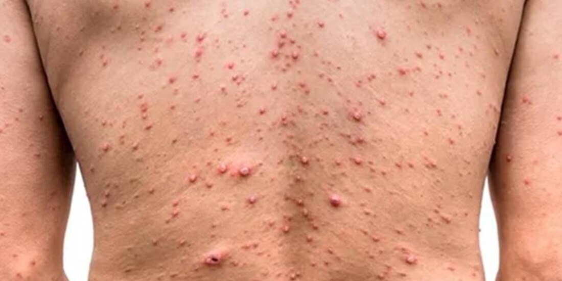 En 80 países se han detectado casos de viruela del mono.