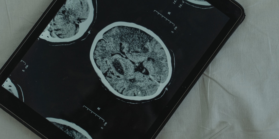 Descubren proteína que podría revertir el Alzheimer al restaurar la memoria