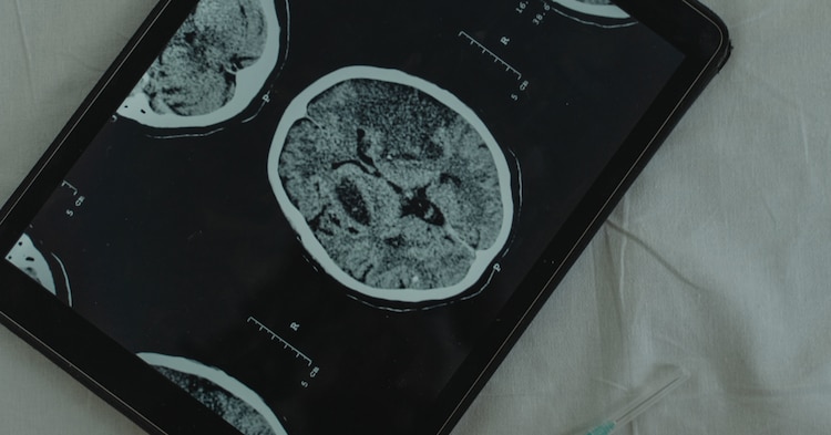 Descubren proteína que podría revertir el Alzheimer al restaurar la memoria