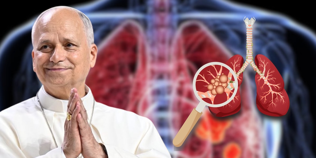 ¿Qué es el adenocarcinoma pulmonar?