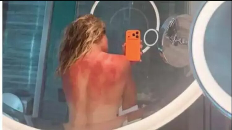 Renata Zarazúa sufrió fuertes quemaduras en Australia.