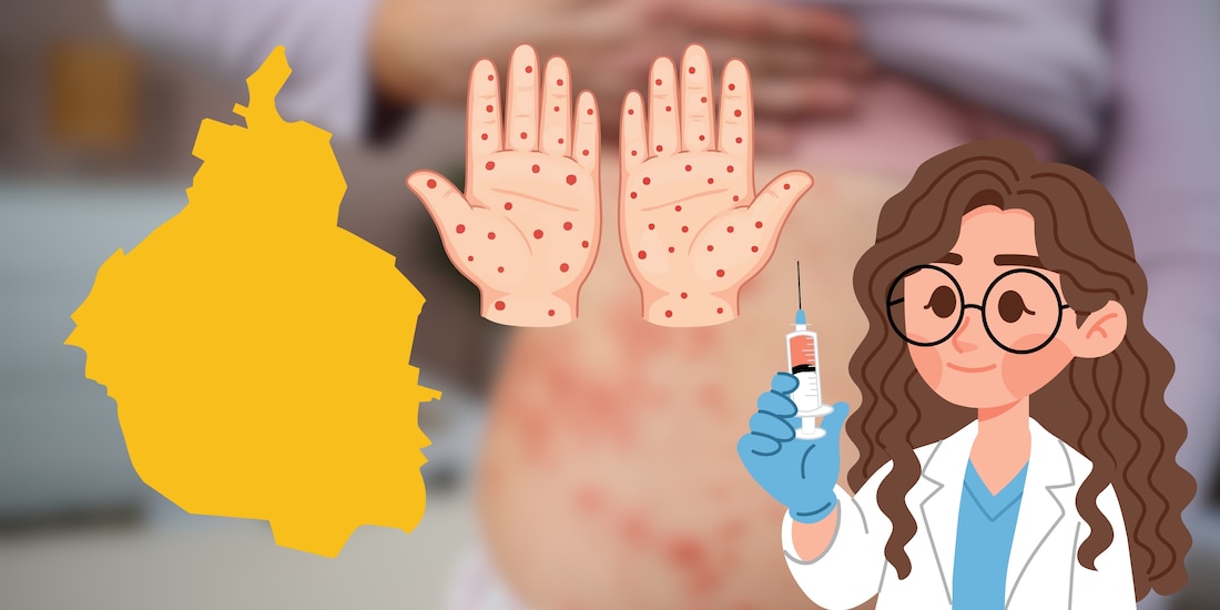 Casos de sarampión confirmados en CDMX