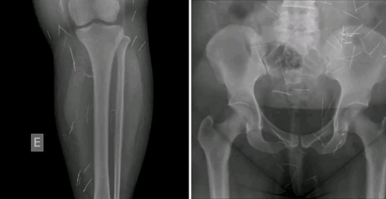 Agujas en el cuerpo de la mujer de 37 años de edad