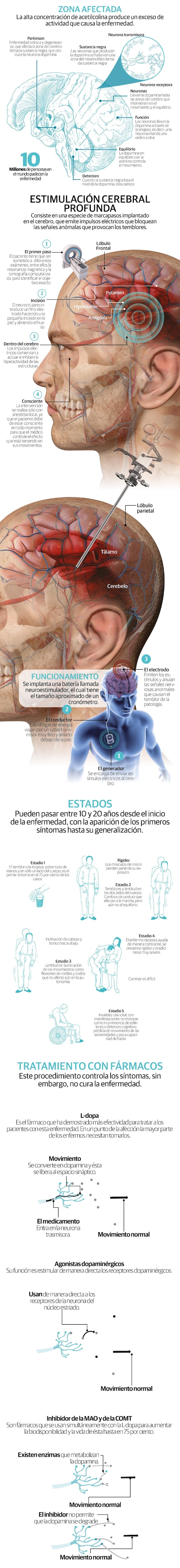 Nuevo método de estimulación cerebral abre esperanzas para tratar el Parkinson