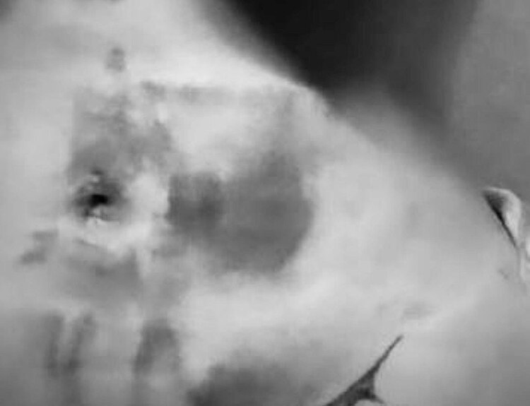 Así quedó Karely Ruiz tras someterse a liposucción; este es el post operatorio