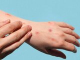 Casos confirmados de viruela del mono se duplican en una semana: Ssa.