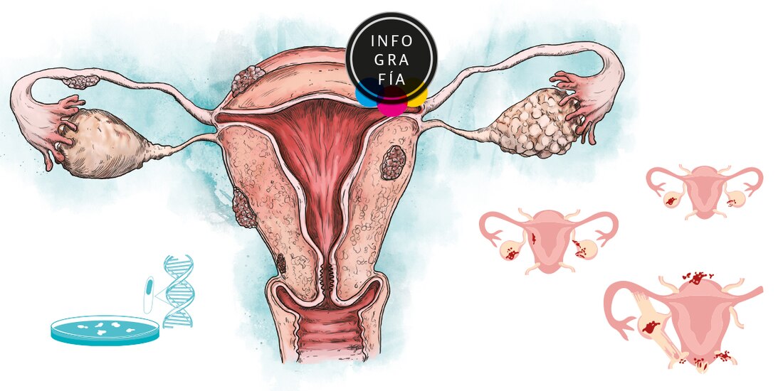 Descubren conexión genética entre la endometriosis y el cáncer de ovario