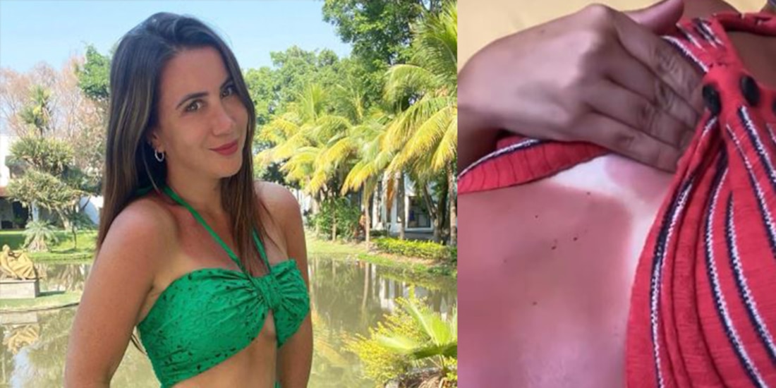 Marialez se lavanta la blusa para mostrar sus quemaduras: 'me arde hasta la conciencia'