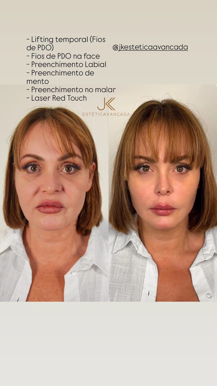 Gaby Spanic comparte el antes y después de sus operaciones estéticas