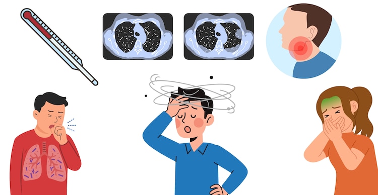 Síntomas del virus Nipah