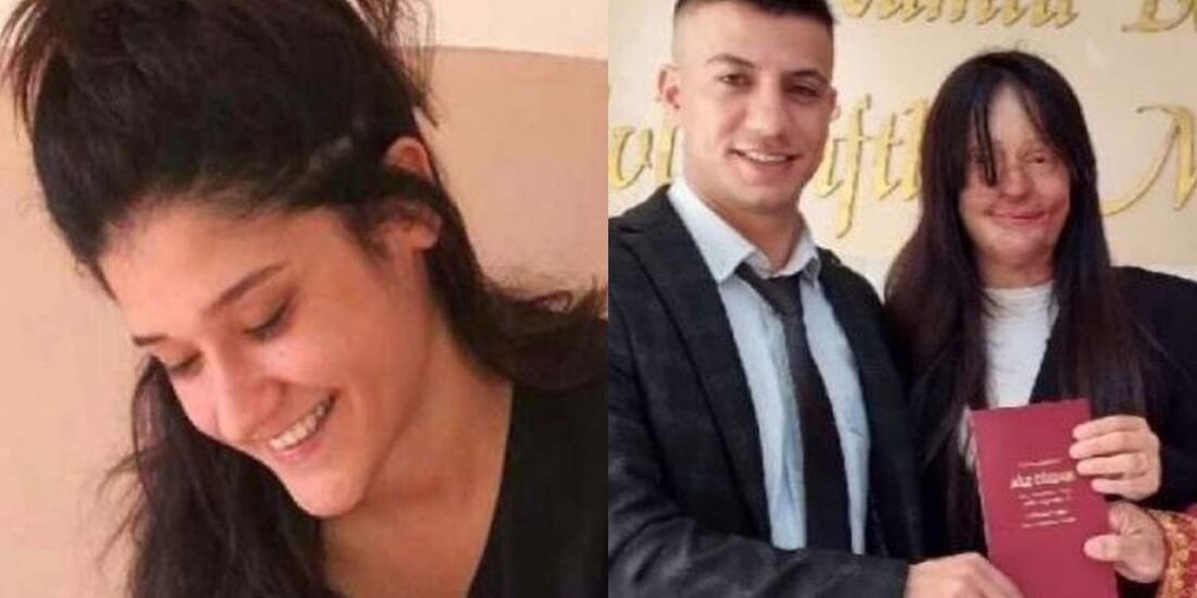 Mujer se casa con el hombre que le lanzó ácido a la cara y su familia no lo puede creer