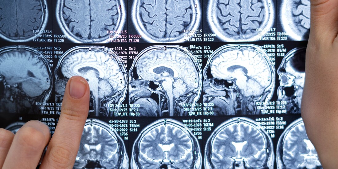 Prevención y detección temprana son claves contra el Ictus