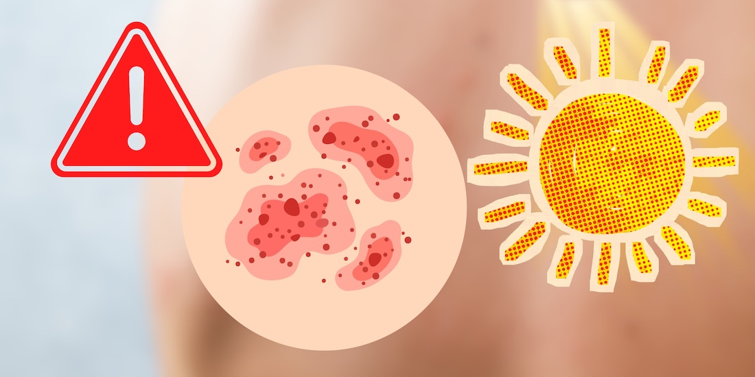 Salpullido por calor