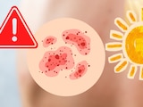 Salpullido por calor