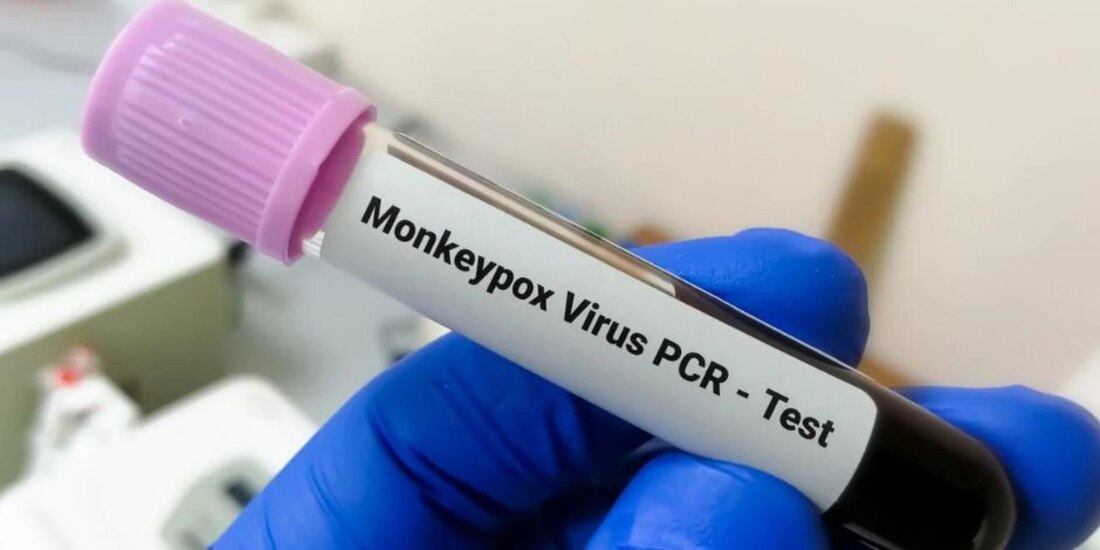 Prueba de viruela del mono.