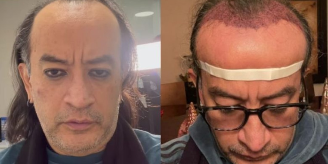 Germán Ortega se hace un injerto de cabello y fans lo destrozan sin piedad: "Pareces Piolín"