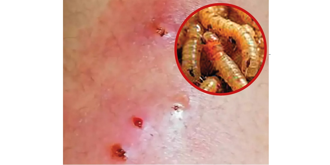 Una persona infestada por el gusano barrenador.