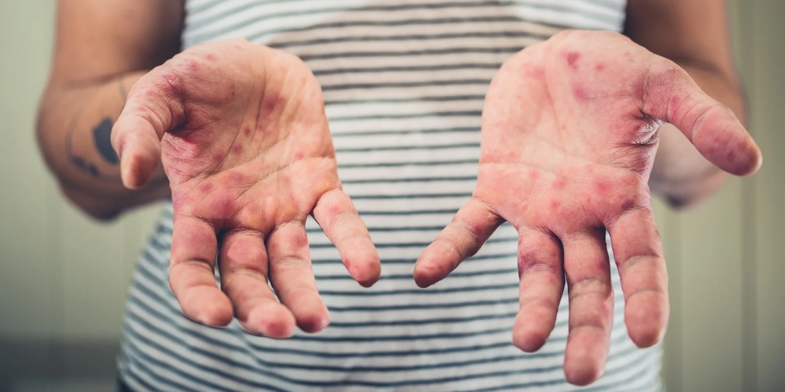 Sarampión imagen ilustrativa