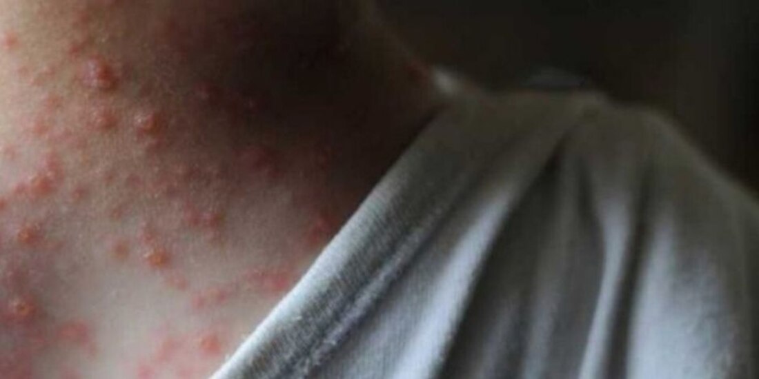 Descartan que la viruela del mono escale a una pandemia