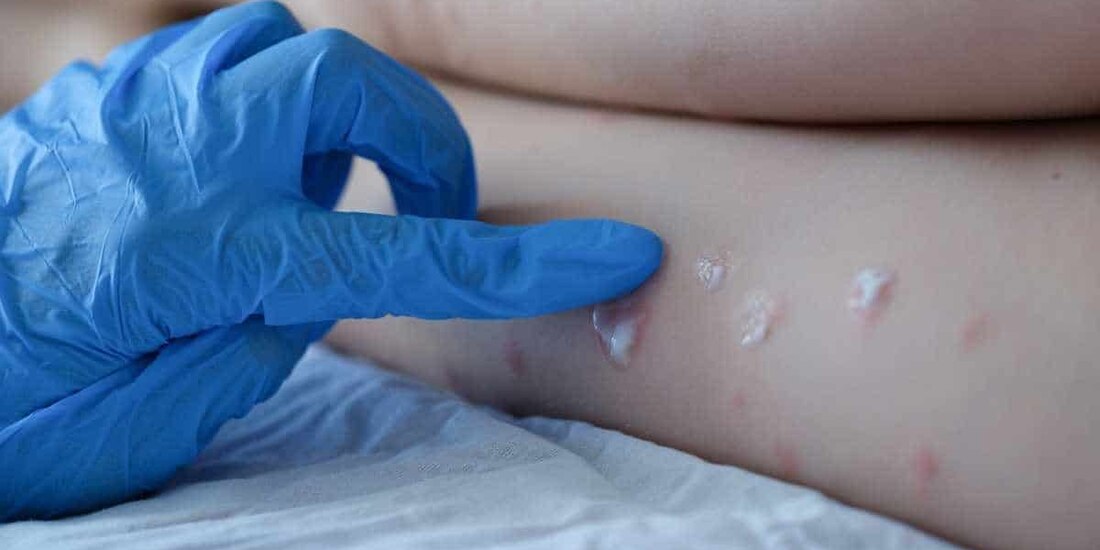 Efectos de la viruela del mono.