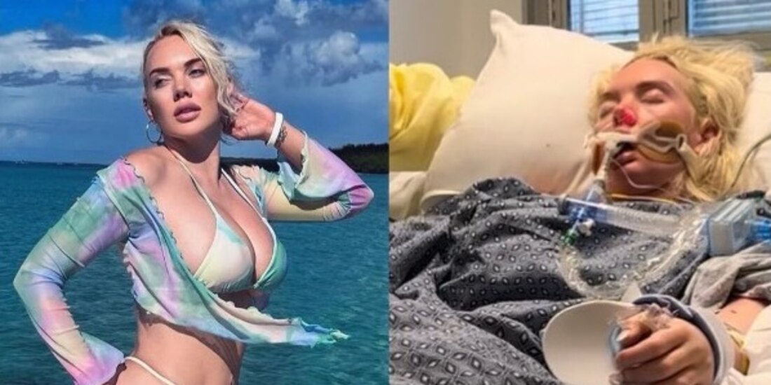 Por bacteria 'come carne' que contrajo en vacaciones, modelo pierde una pierna.