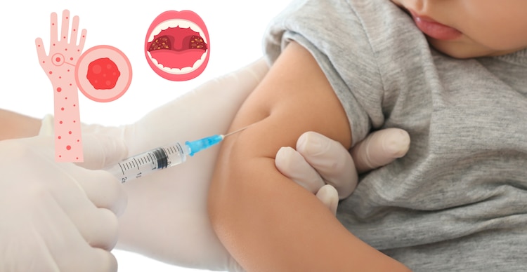 ¿Dónde vacunarme contra el sarampión en CDMX?