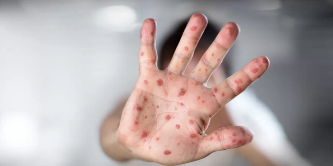 Sarampión se propaga a
las 32 entidades del país