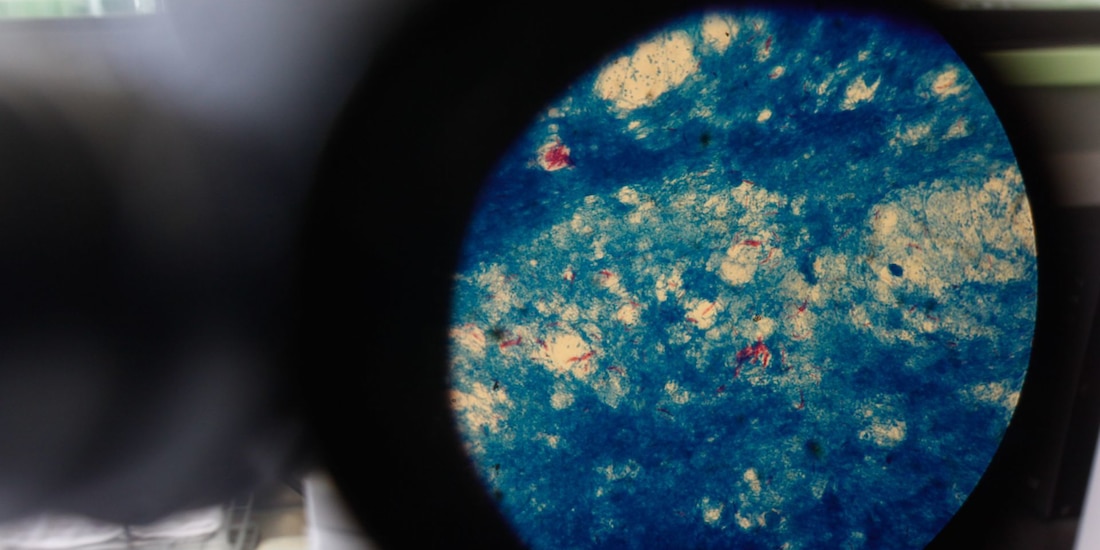 En la imagen de archivo se observa una muestra sanguínea a través del microscopio de un enfermo con tuberculosis