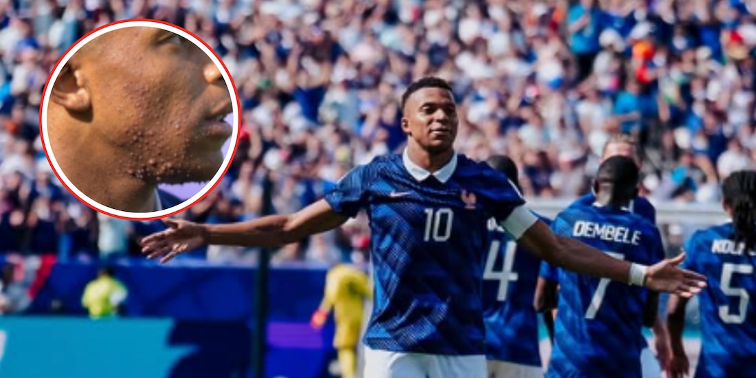 ¿Qué se ha hecho Mbappé en la cara?