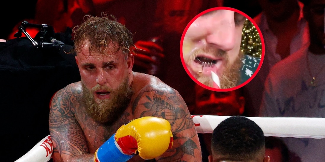 Jake Paul quedó irreconocible tras la fractura de mandíbula que le provocó Anthony Joshua.
