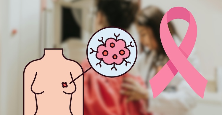 Detección oportuna del cáncer de mama