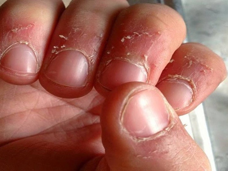 Padrastros en los dedos.