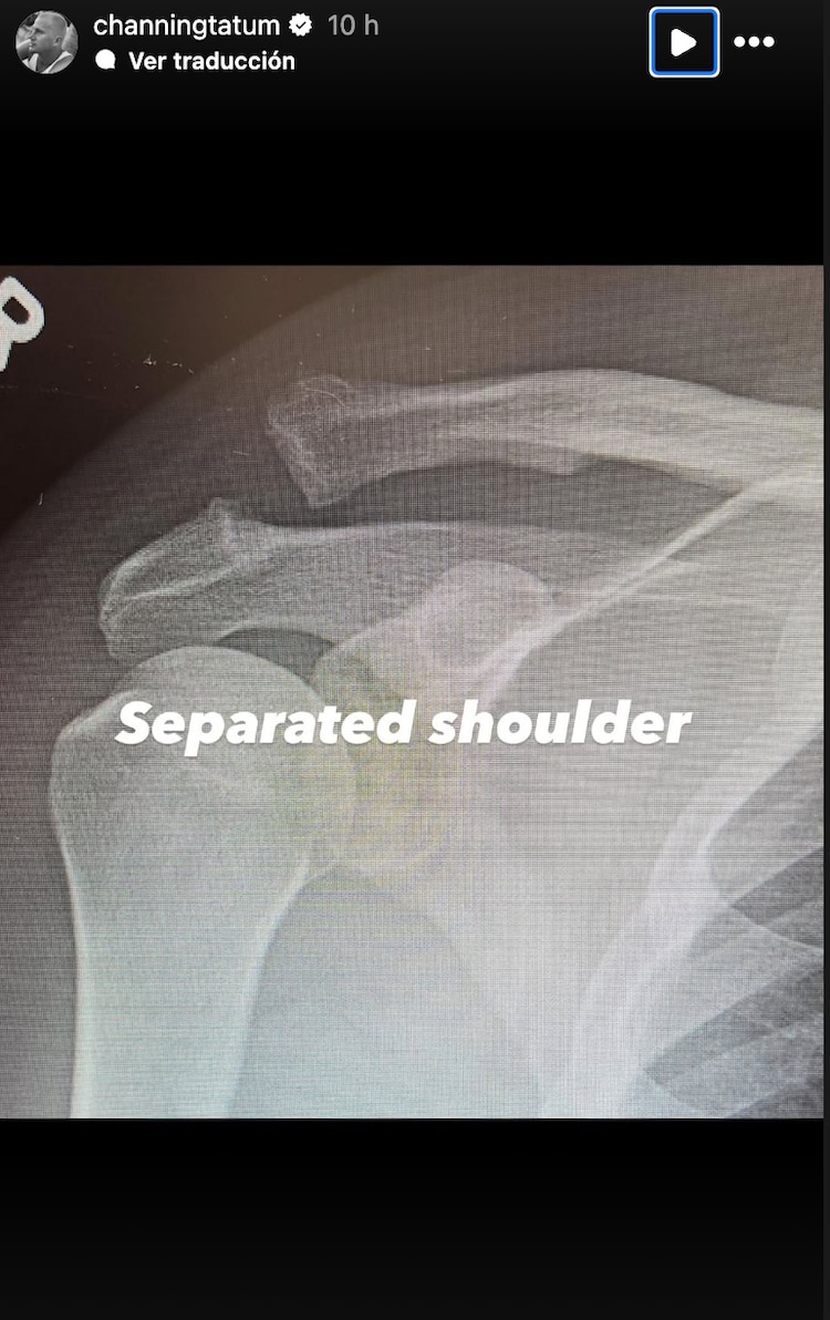 A Channing Tatum lo operaron porque tenía el hombro separado