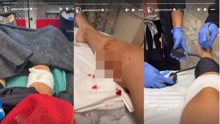 Así le quedó la pierna a Gaby Ramírez tras ser atacada por un perro