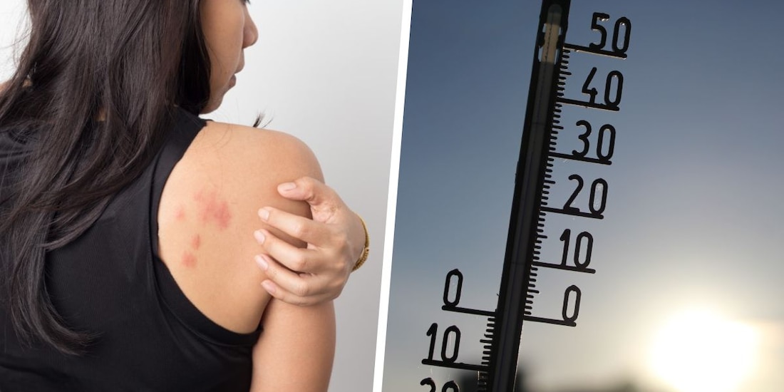 El sarpullido es una de las consecuencias por el calor; te decimos cómo remediarlo.