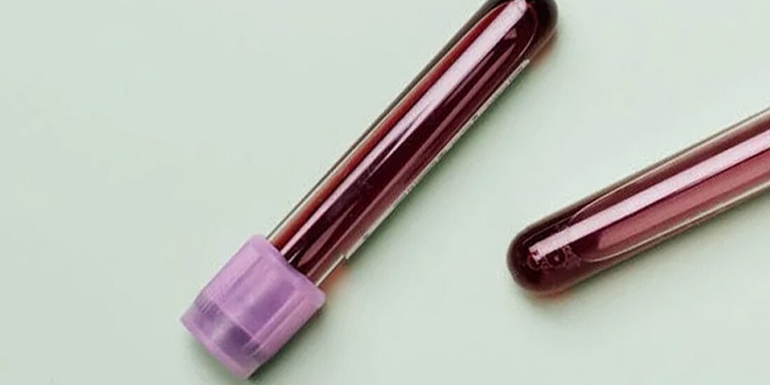 En la imagen ilustrativa, un test de sangre │ Una menor, primera víctima de gripe aviar