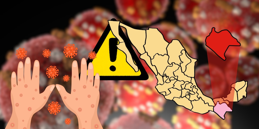 Sarampión en Chiapas