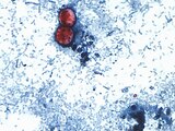 Esta fotografía tomada a través de un microscopio y difundida por los CDC muestra Cyclospora cayetanensis oocysts de una muestra de heces.