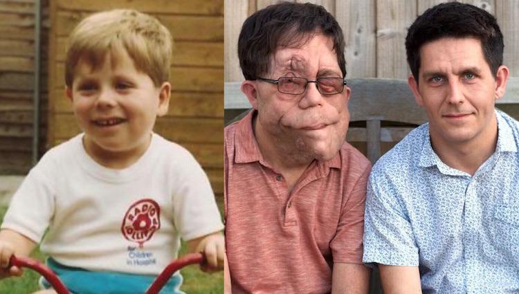 Adam Pearson en su niñez; Adam con su hermano gemelo Neil.