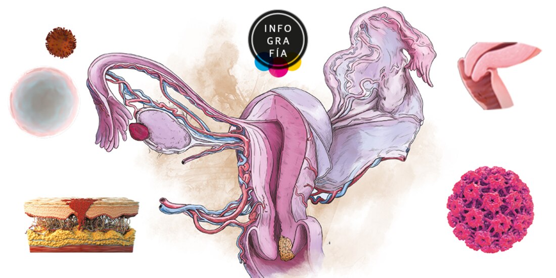 Identifican proceso del VPH causante de cáncer cervicouterino