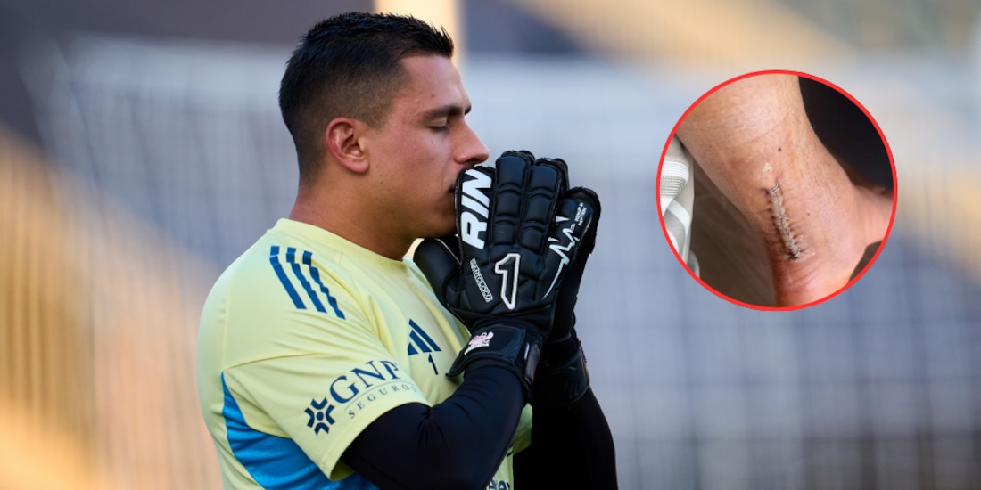 Luis Ángel Malagón enseña como quedó su pierna tras la operación.