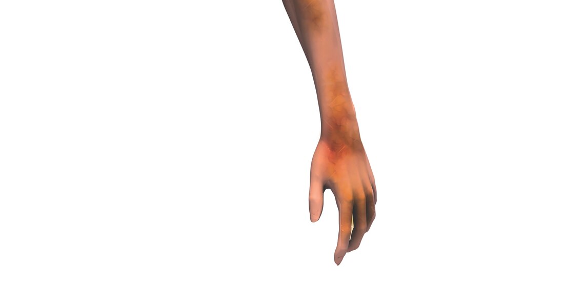 Alerta OMS: viruela del mono