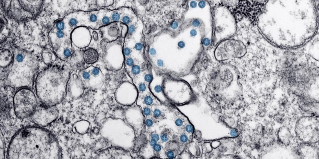 Partículas del virus SARS-CoV-2, coloreadas en azul, en una imagen de microscopio de electrones.