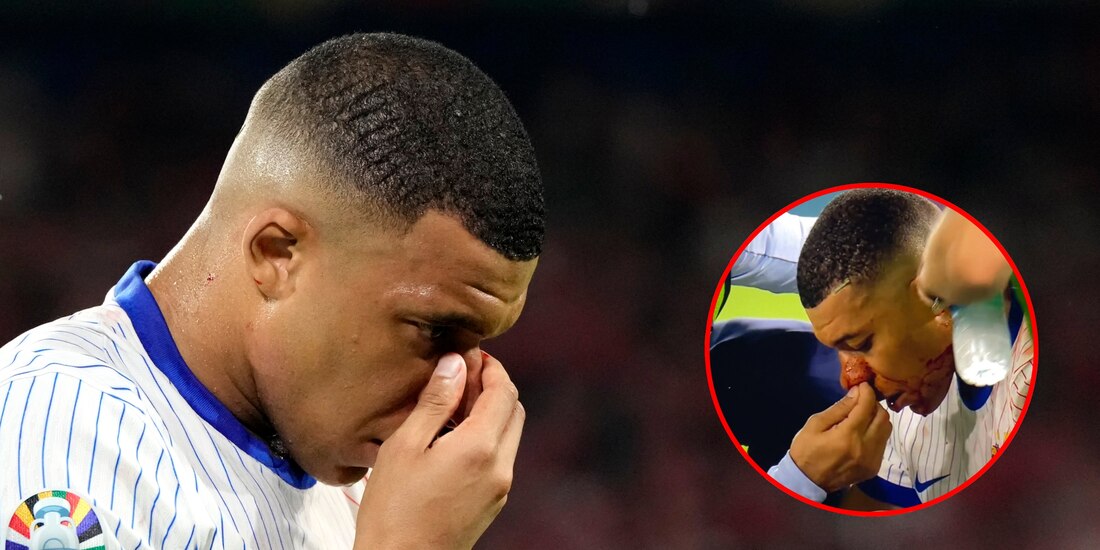 Kylian Mbappé sufre fuerte golpe con un rival y su nariz queda destrozada