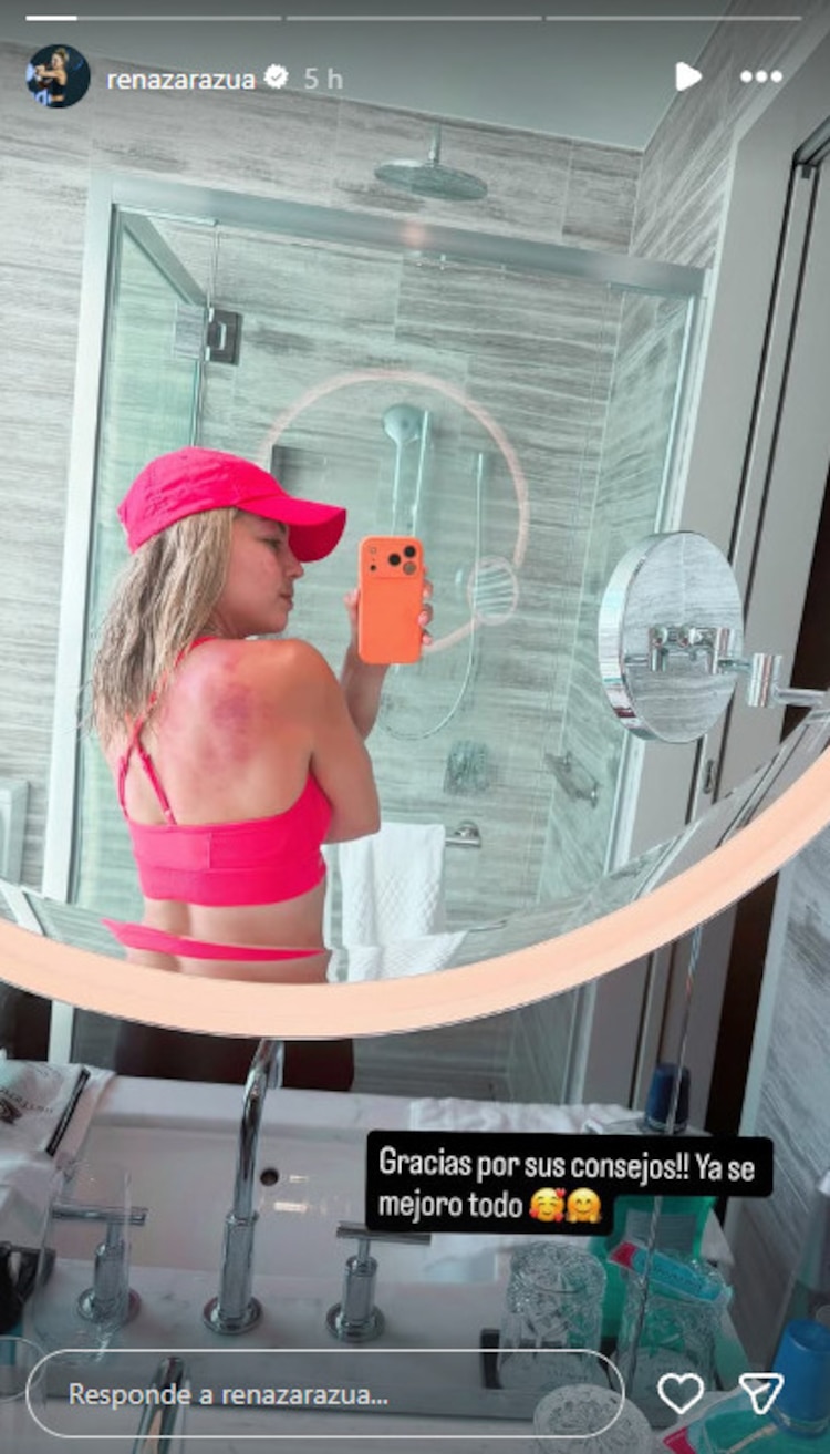 Renata Zarazúa agradeció a sus seguidores por sus consejos para combatir las quemaduras.