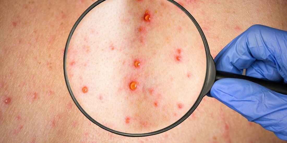 Suman 5 mil contagios por la viruela del mono en el mundo